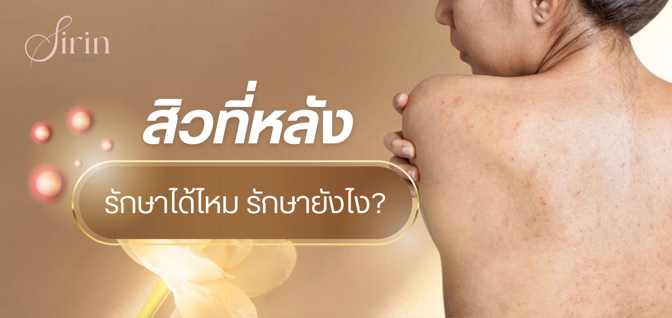 สิวที่หลัง รักษาได้ไหม รักษายังไง